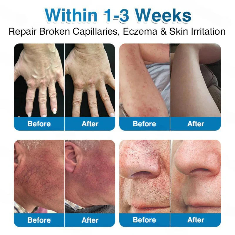 🏅🏃 Microneedle Patch Roll⚡Instant Relief, Long-Term Results✨