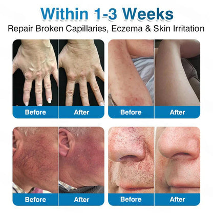 🏅🏃 Microneedle Patch Roll⚡Instant Relief, Long-Term Results✨